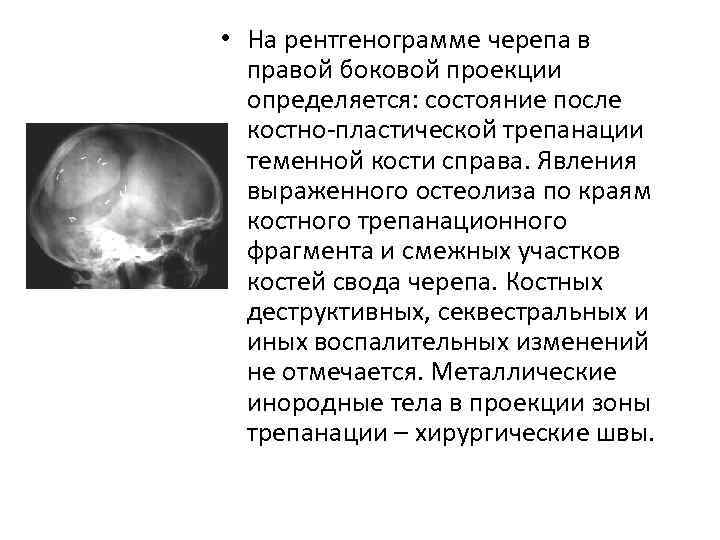  • На рентгенограмме черепа в правой боковой проекции определяется: состояние после костно-пластической трепанации