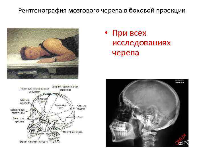 Рентгенография мозгового черепа в боковой проекции • При всех исследованиях черепа 