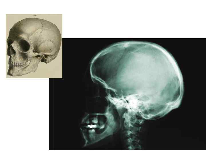 Рентгенограммы перелома лобной кости