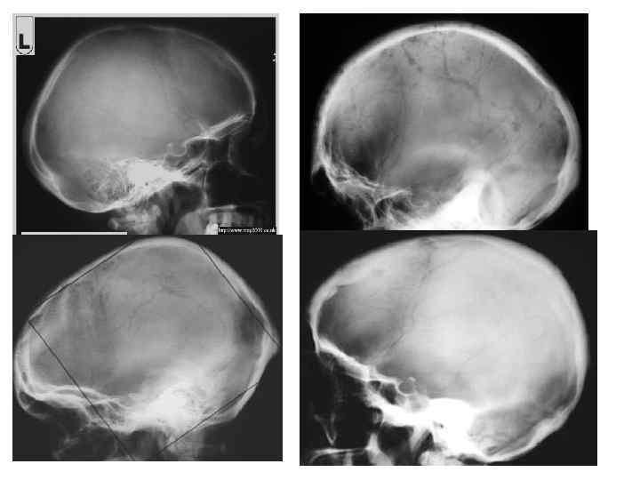 Рентгенография перелома черепа
