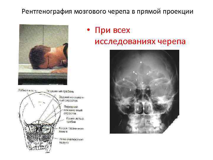 Рентгенография мозгового черепа в прямой проекции • При всех исследованиях черепа 
