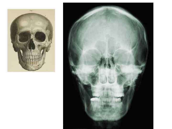 Перелом теменной кости рентген