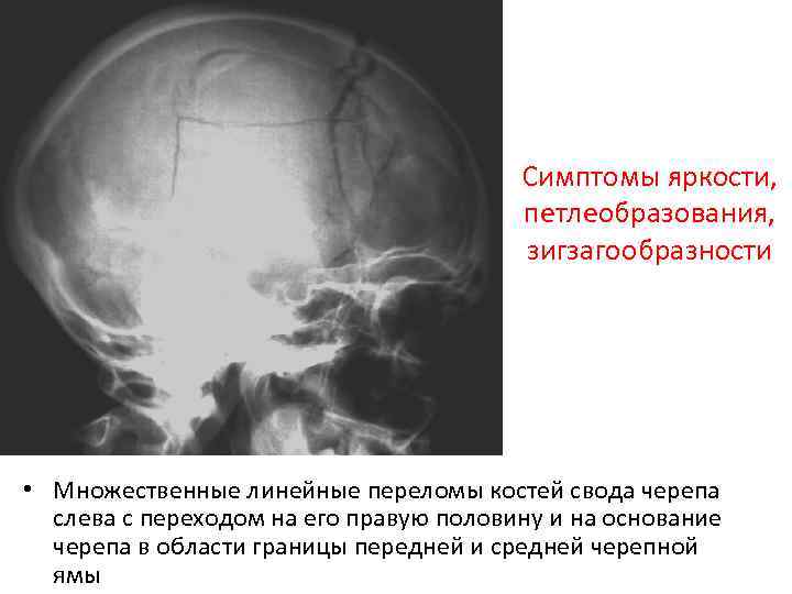 Симптомы яркости, петлеобразования, зигзагообразности • Множественные линейные переломы костей свода черепа слева с переходом