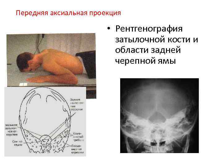 Передняя аксиальная проекция • Рентгенография затылочной кости и области задней черепной ямы 