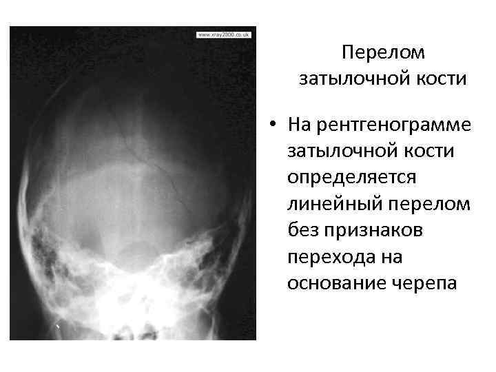 Перелом основания свода. Перелом затылочной кости черепа рентген. Перелом затылочной кости рентген. Линейный перелом затылочной кости с переходом на основание черепа. Перелом теменной кости на кт.