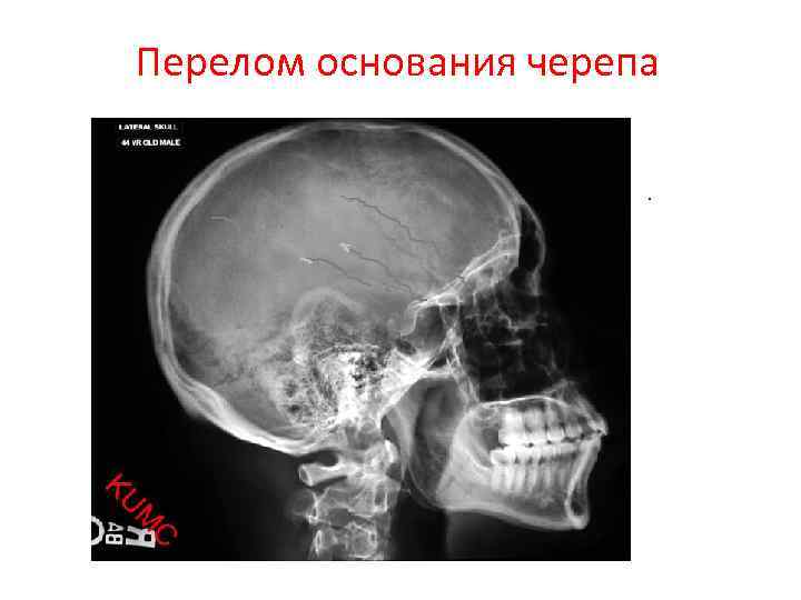 Кости черепа рентген