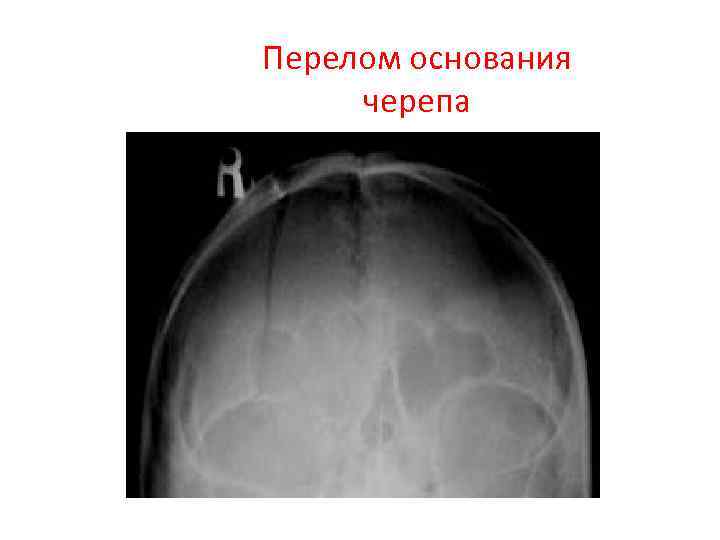 Перелом основания черепа 