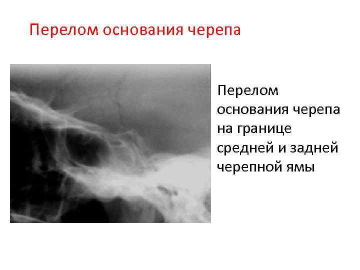 Перелом основания черепа • Перелом основания черепа на границе средней и задней черепной ямы
