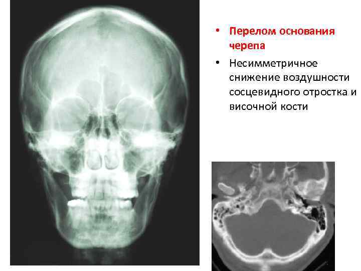  • Перелом основания черепа • Несимметричное снижение воздушности сосцевидного отростка и височной кости