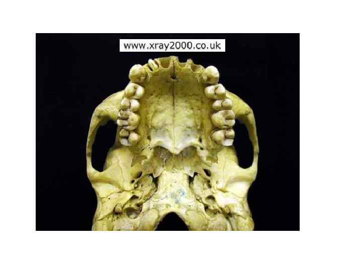 Рентгенодиагностика переломов костей черепа