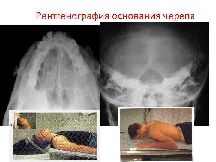 Рентгенография основания черепа 