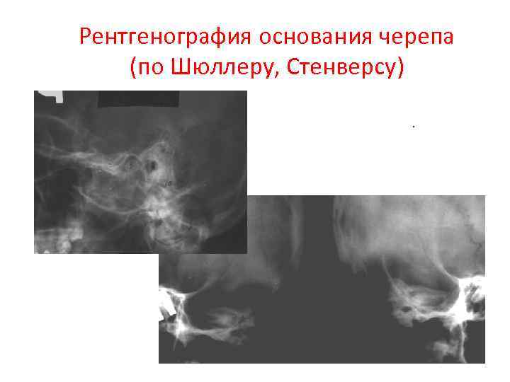 Рентгенография основания черепа (по Шюллеру, Стенверсу) 
