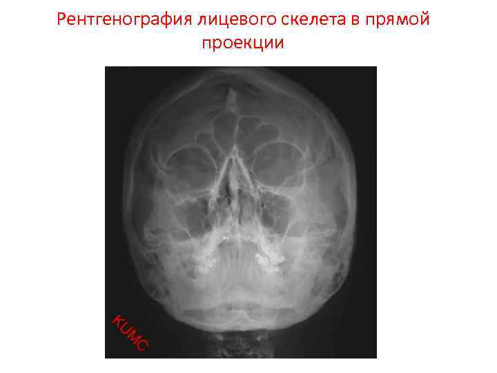 Рентгенография лицевого скелета в прямой проекции 