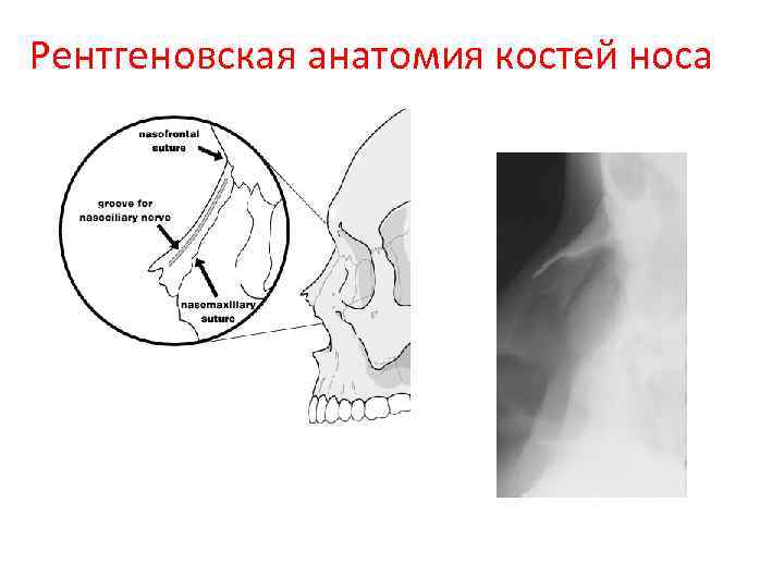 Рентгеновская анатомия костей носа 