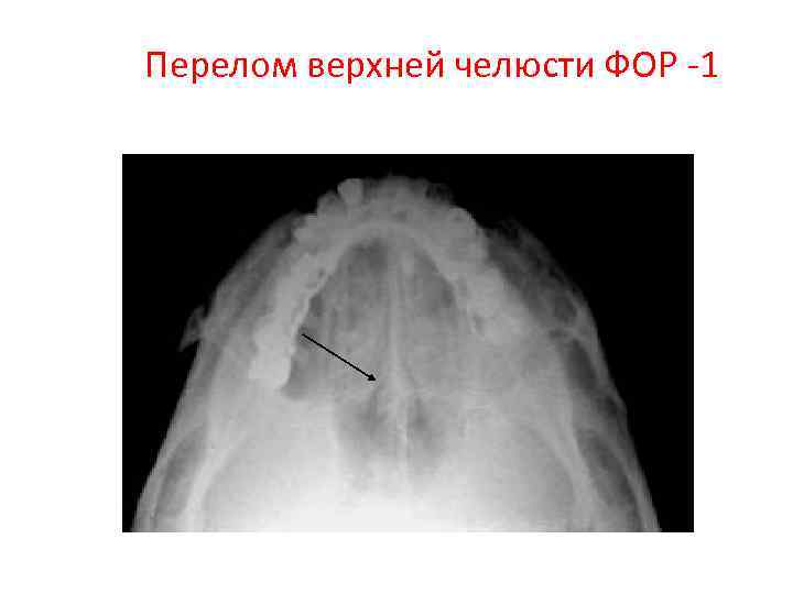 Перелом верхней челюсти ФОР -1 