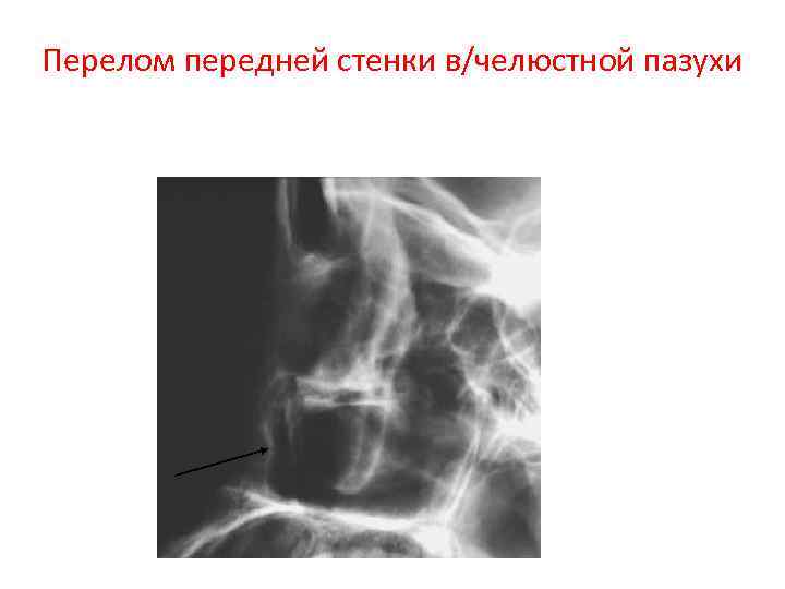 Рентген признаки перелома костей черепа thumbnail