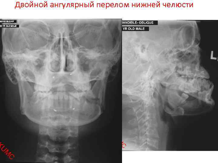 Двойной ангулярный перелом нижней челюсти 