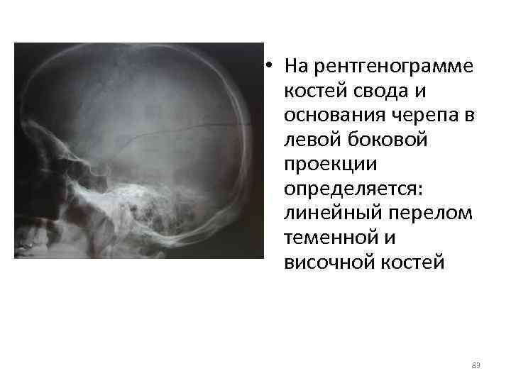  • На рентгенограмме костей свода и основания черепа в левой боковой проекции определяется: