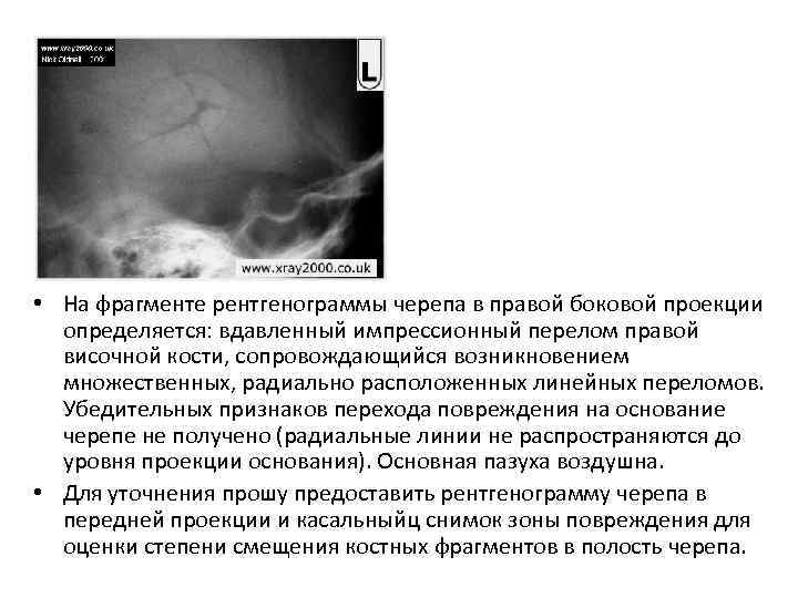  • На фрагменте рентгенограммы черепа в правой боковой проекции определяется: вдавленный импрессионный перелом