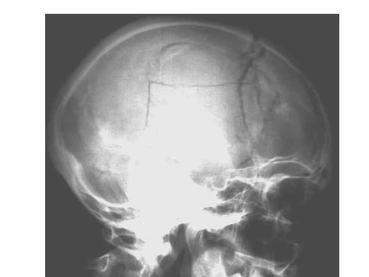 Признаки перелома черепа на рентгенограмме