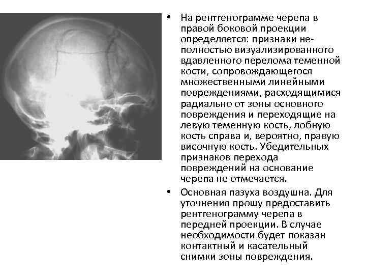  • На рентгенограмме черепа в правой боковой проекции определяется: признаки неполностью визуализированного вдавленного