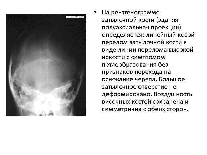  • На рентгенограмме затылочной кости (задняя полуаксиальная проекция) определяется: линейный косой перелом затылочной