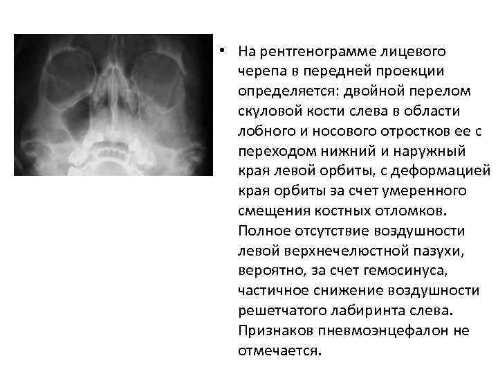  • На рентгенограмме лицевого черепа в передней проекции определяется: двойной перелом скуловой кости