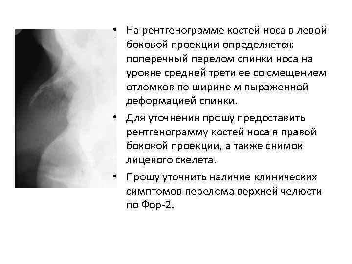  • На рентгенограмме костей носа в левой боковой проекции определяется: поперечный перелом спинки