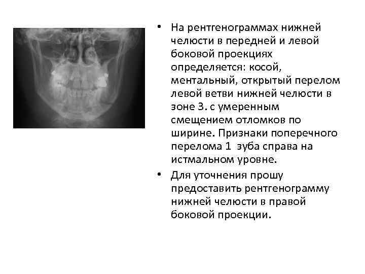  • На рентгенограммах нижней челюсти в передней и левой боковой проекциях определяется: косой,