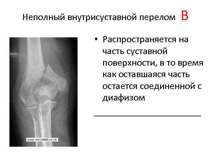 Переломы плечевой кости презентация