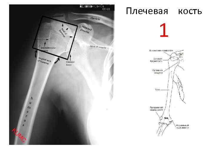 Открытый перелом плечевой кости карта вызова