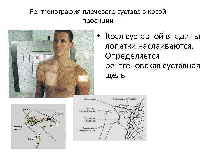 Рассмотрите рентгенограмму с изображением плечевого сустава человека как называют повреждение