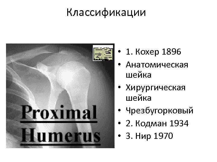 Хирургическая шейка плечевой кости мкб 10