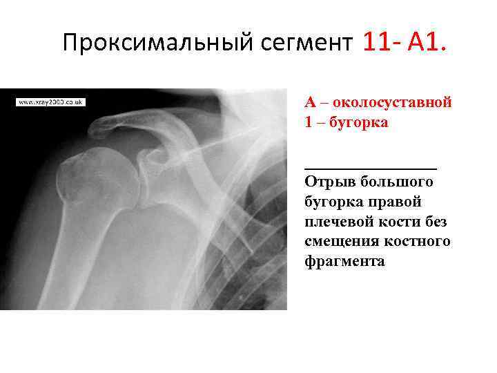 Перелом большого бугорка плечевой кости без смещения