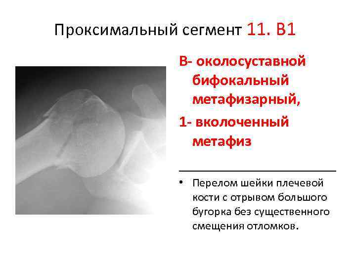 Перелом большого бугорка плечевой кости форум