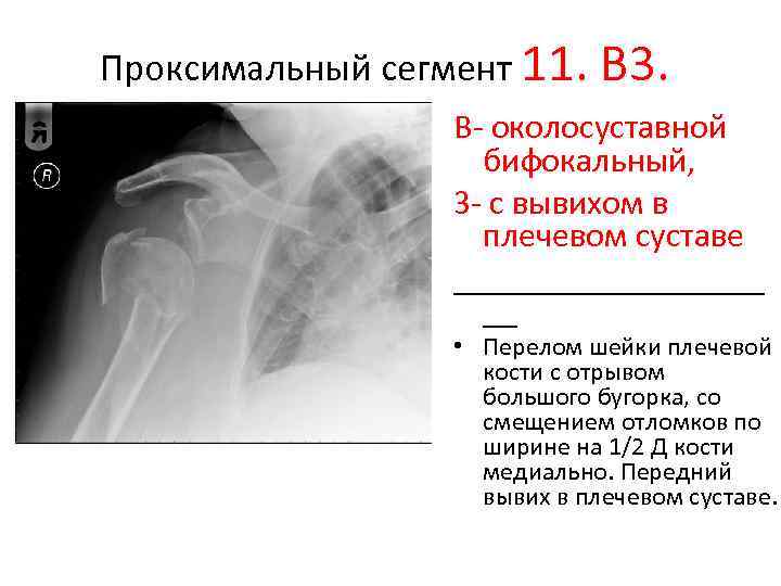 Проксимальные переломы плечевой кости