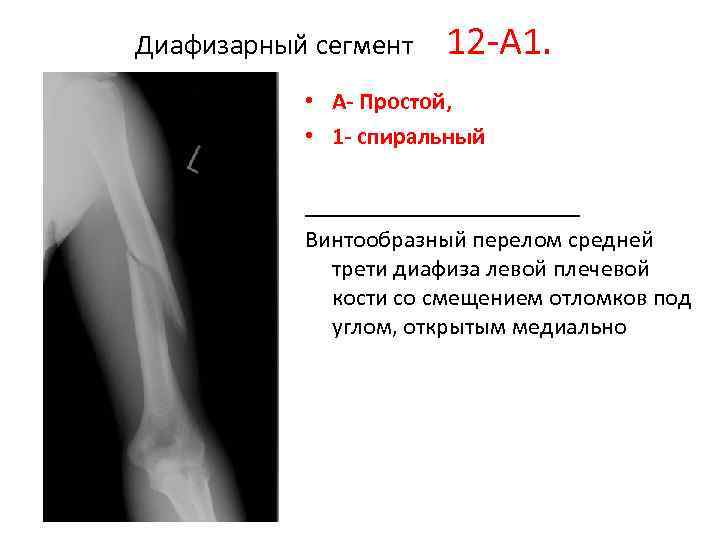 Диафиза плечевой кости. Перелом диафиза плечевой кости. Перелом средней трети плечевой кости. Рентгенограмма перелом диафиза плечевой кости. Закрытый винтообразный перелом средней трети диафиза плечевой кости.