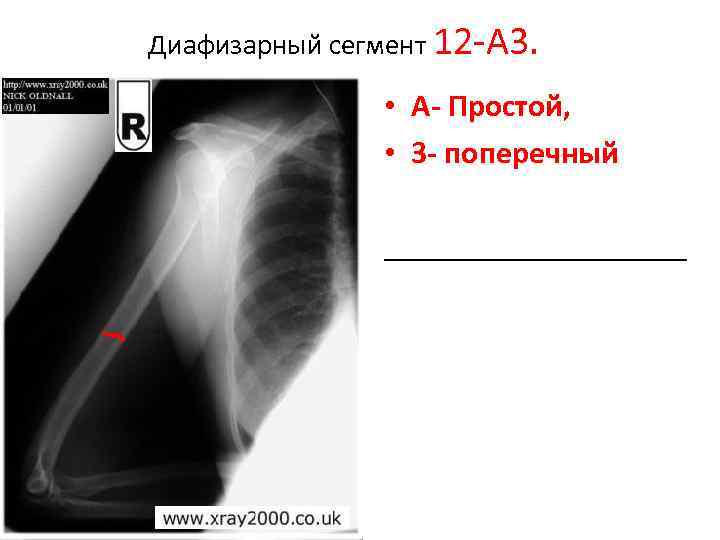 Диафизарный перелом плечевой кости