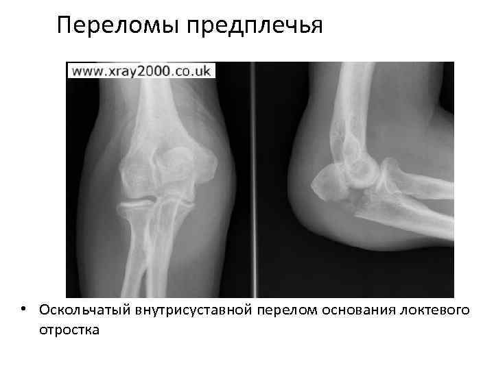 Перелом предплечья симптомы