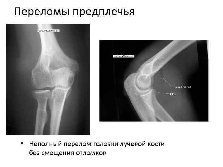 Головка лучевой кости