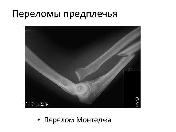 Перелом предплечья. Переломовывих Монтеджи. Сгибательный перелом Монтеджи. Переломовывих Монтеджи сгибательный. Перелом Монтеджи рентген.