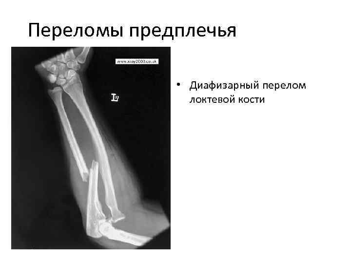 Перелом локтевой кости. Изолированные переломы диафиза локтевой кости. Диафизарные переломы костей предплечья классификация. Диафизарные переломы обеих костей предплечья. Описание перелома диафиза локтевой кости.