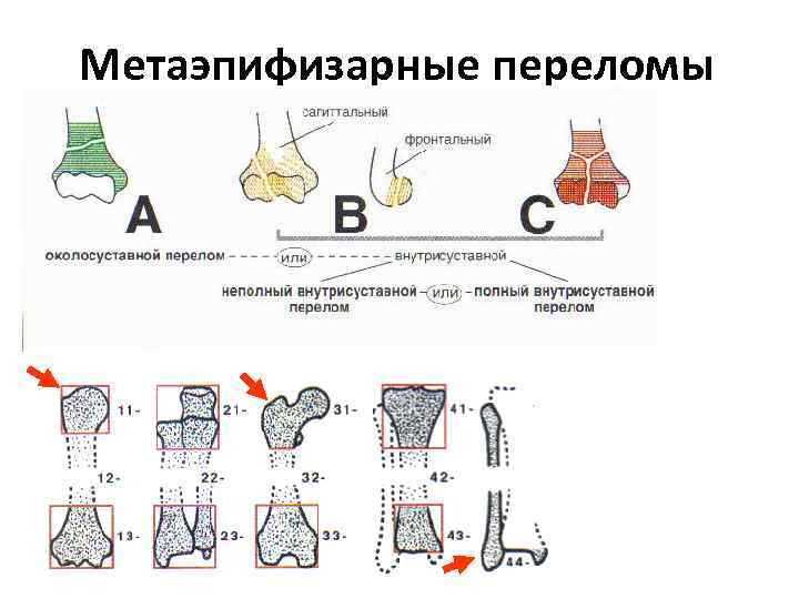 Классификация переломов лопатки рисунок