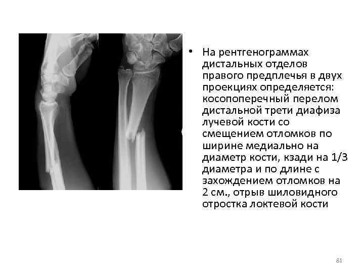 Перелом предплечья симптомы