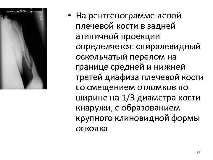 Средняя треть плечевой кости. Протокол рентгена плечевой кости. Рентгенограмма перелома плечевой кости в боковой проекции. Рентгенограмма перелома плечевой кости в двух проекциях. Перелом плечевой кости описание рентгенограммы.