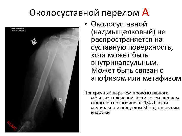 Перелом нижней трети предплечья карта вызова