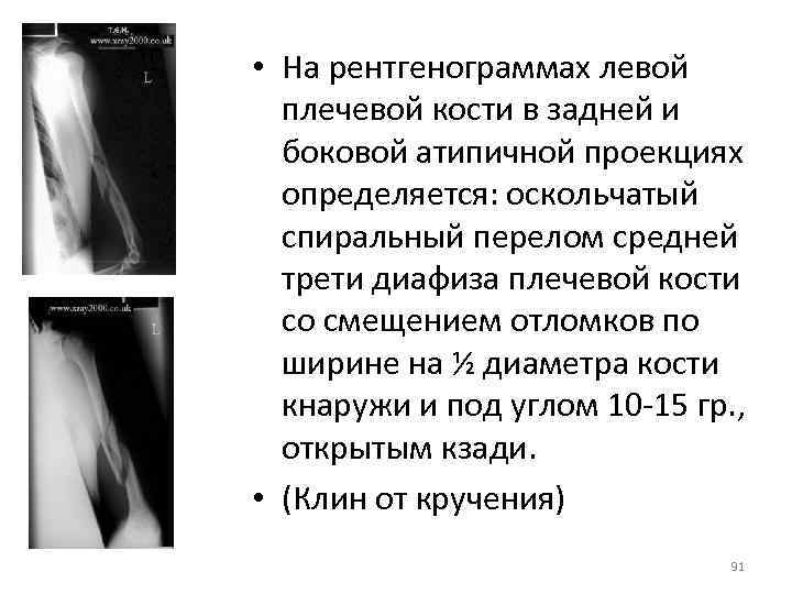 Рассмотрите рентгенограмму с изображением голени человека как называют повреждение которое