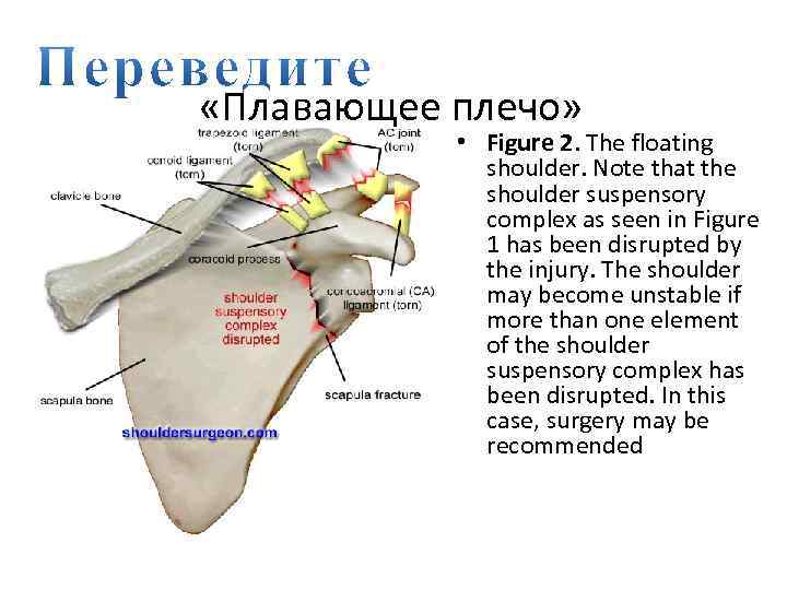  «Плавающее плечо» • Figure 2. The floating shoulder. Note that the shoulder suspensory