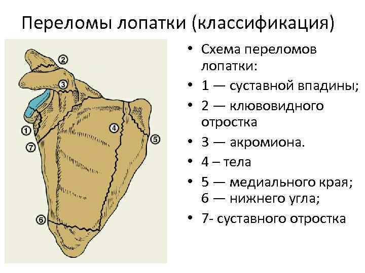 Переломы лопатки презентация