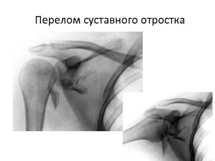 Перелом суставного отростка 